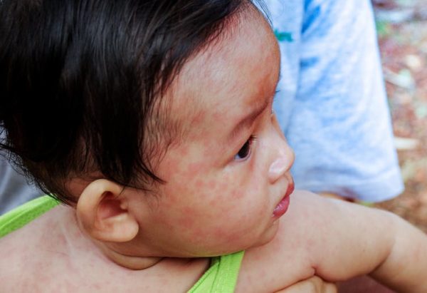 Why parents should fear measles, not the vaccine